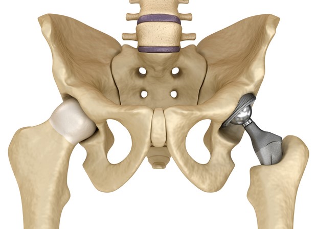Hip implant.jpg