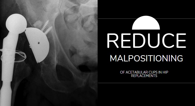 Reduce Malpositioning of Acetabular Cups.jpg