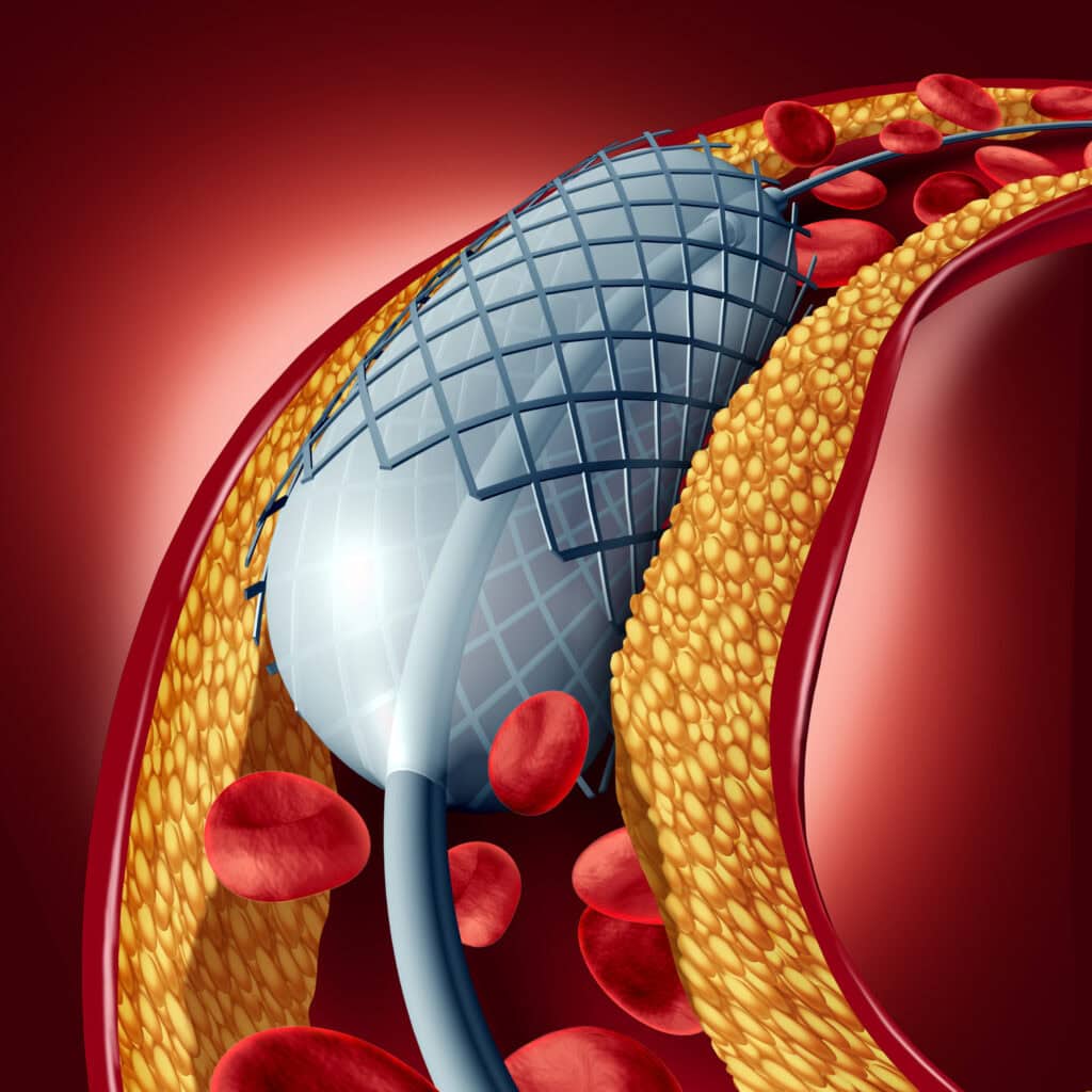 Drug-Eluting Stents: Tracking Polymer Coating Degradation and API Release Drug-Eluting Stents: Tracking Polymer Coating Degradation and API Release
