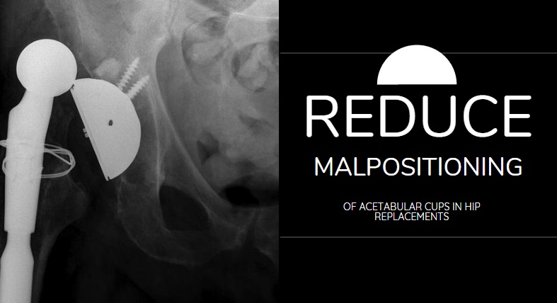 CPG Researchers Receive Hip Replacement Positioning Patent CPG Researchers Receive Hip Replacement Positioning Patent