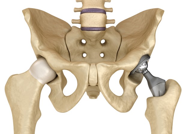 Metal-on-Metal Hip Implants
