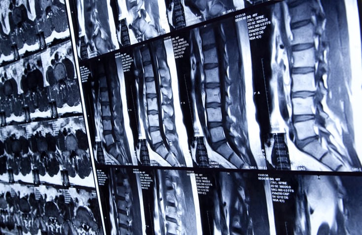 Radiopacity of Medical Implants Radiopacity of Medical Implants